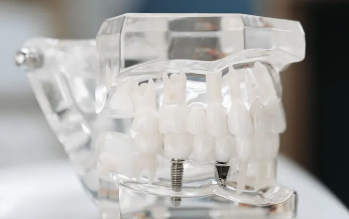 Modello trasparente di una mascella con impianti dentali