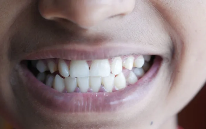 Primo piano di un sorriso con denti chiari