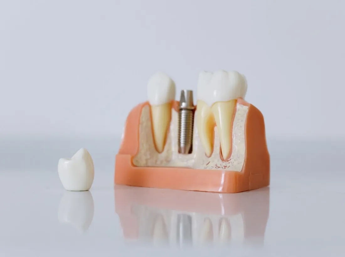 Modello di un impianto dentale con la corona accanto
