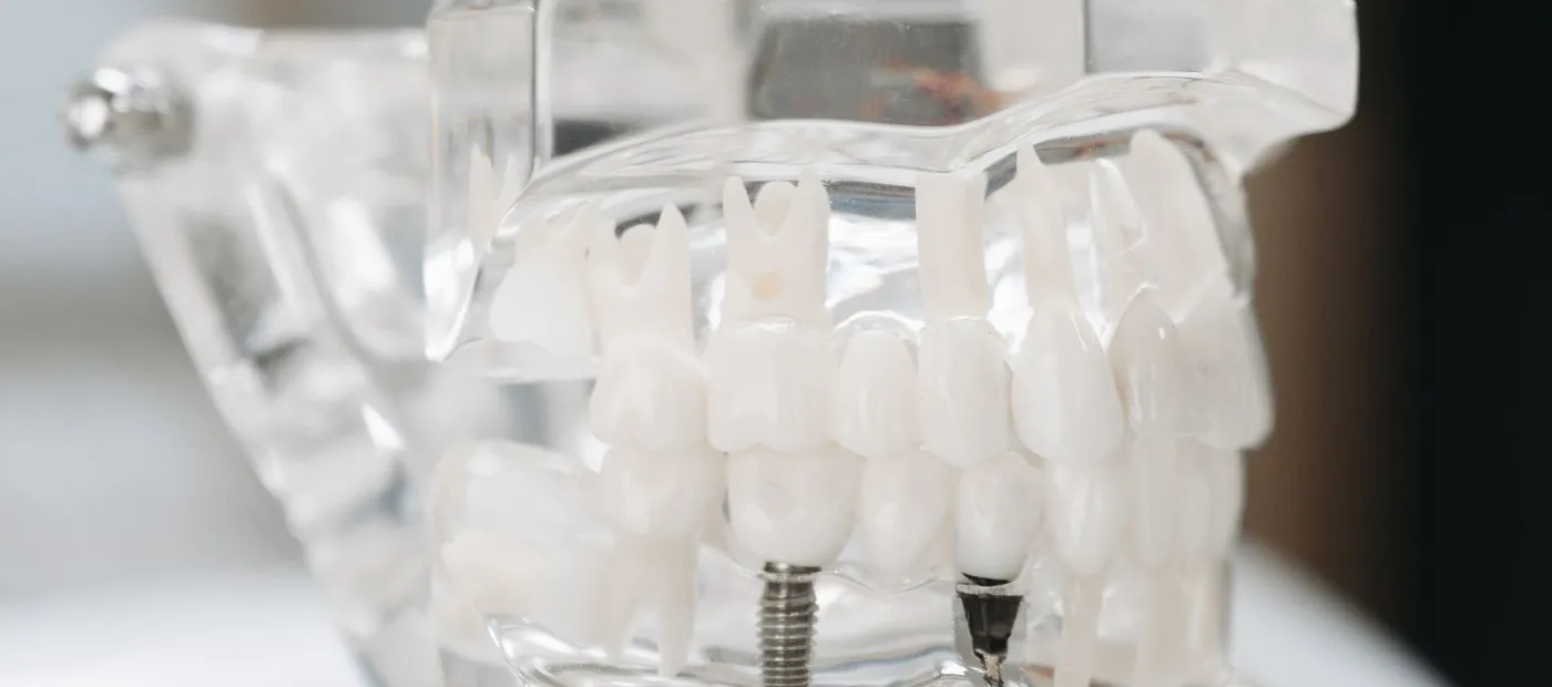 Modello trasparente di una mascella con impianti dentali
